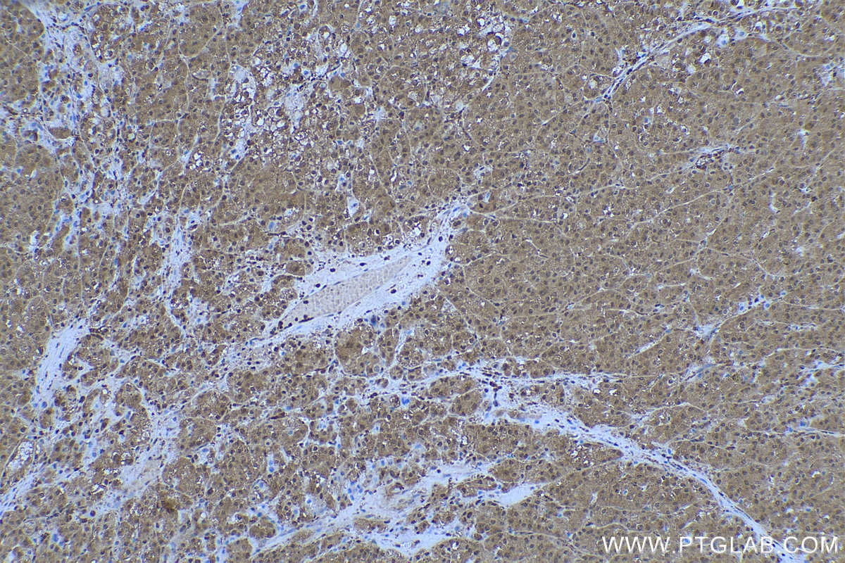 Immunohistochemistry (IHC) staining of human liver cancer tissue using PGK1 Monoclonal antibody (68035-1-Ig)
