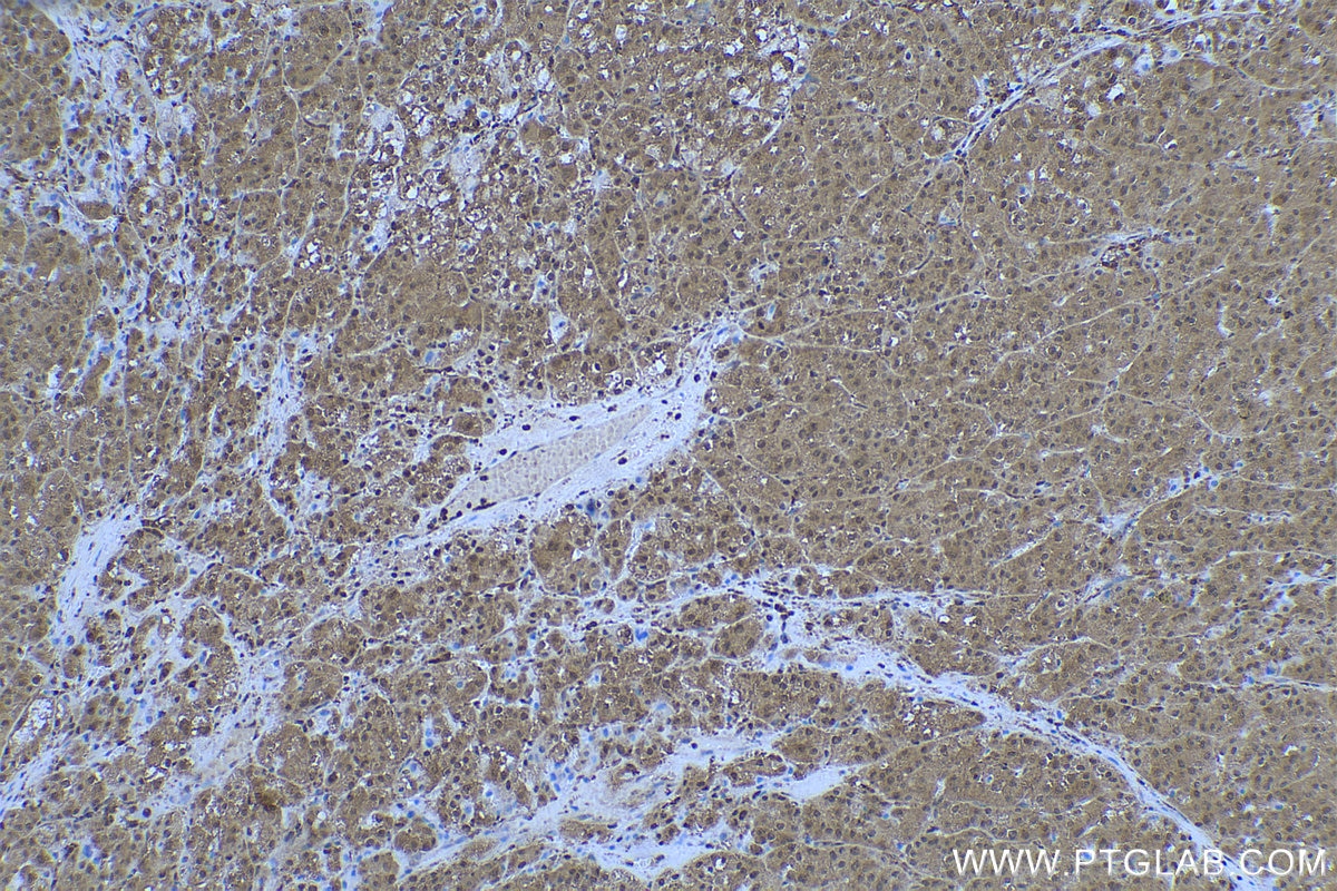 IHC staining of human liver cancer using 68035-1-Ig