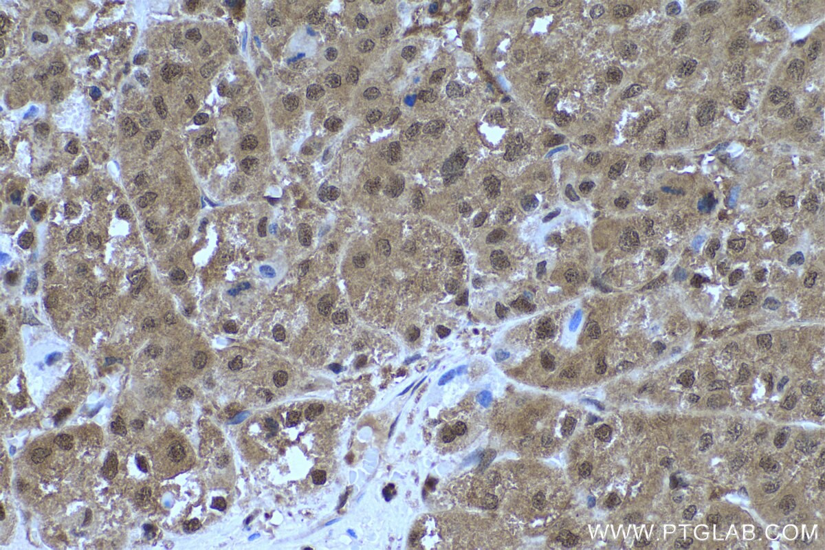 Immunohistochemistry (IHC) staining of human liver cancer tissue using PGK1 Monoclonal antibody (68035-1-Ig)