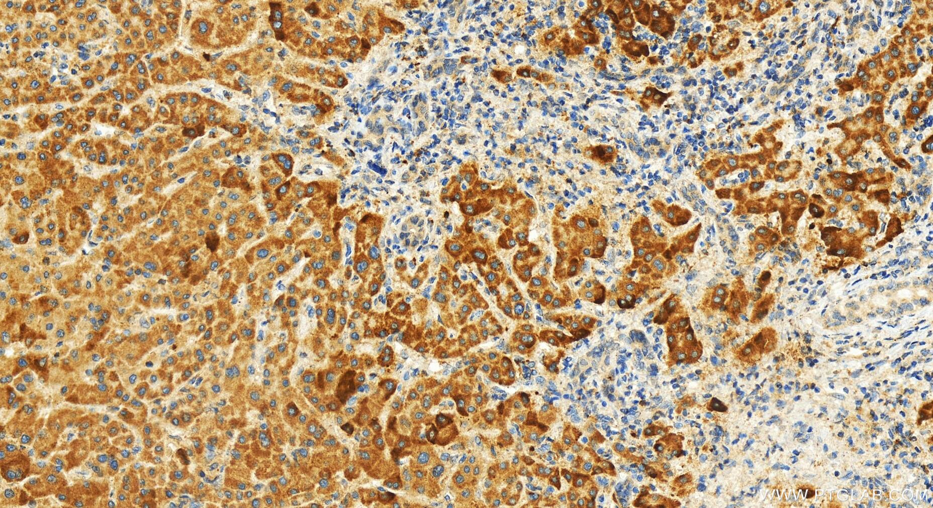 Immunohistochemistry (IHC) staining of human intrahepatic cholangiocarcinoma tissue using PGLYRP1 Polyclonal antibody (18046-1-AP)