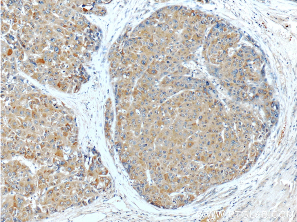 Immunohistochemistry (IHC) staining of human liver cancer tissue using PGLYRP2 Polyclonal antibody (23029-1-AP)