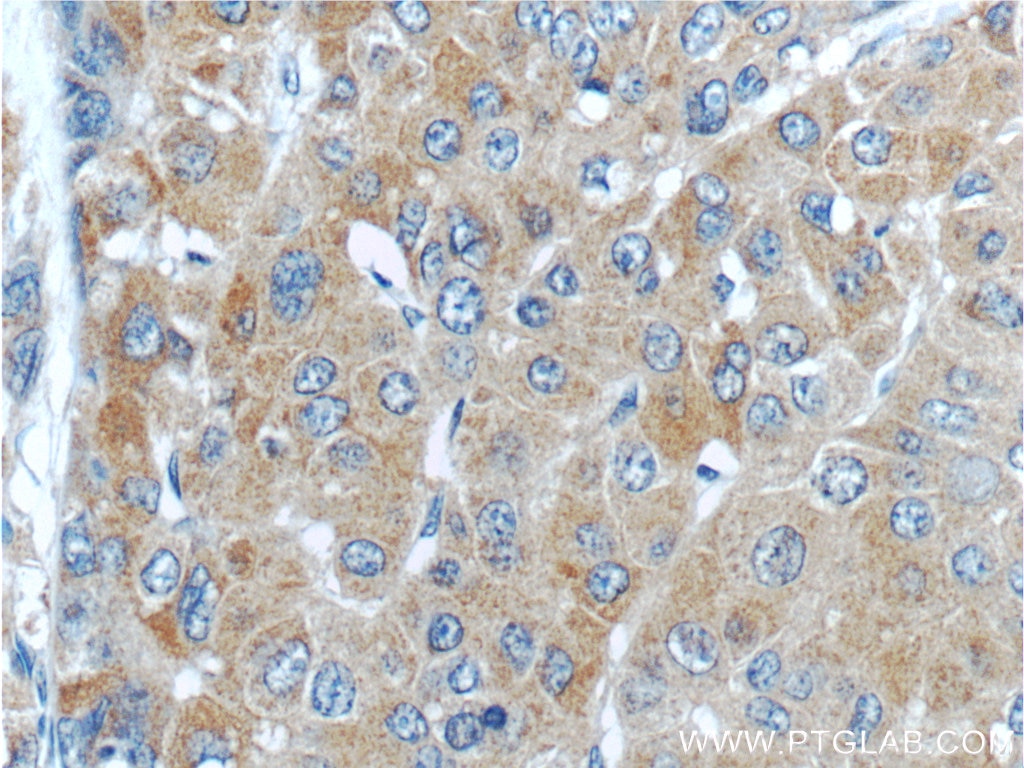 Immunohistochemistry (IHC) staining of human liver cancer tissue using PGLYRP2 Polyclonal antibody (23029-1-AP)