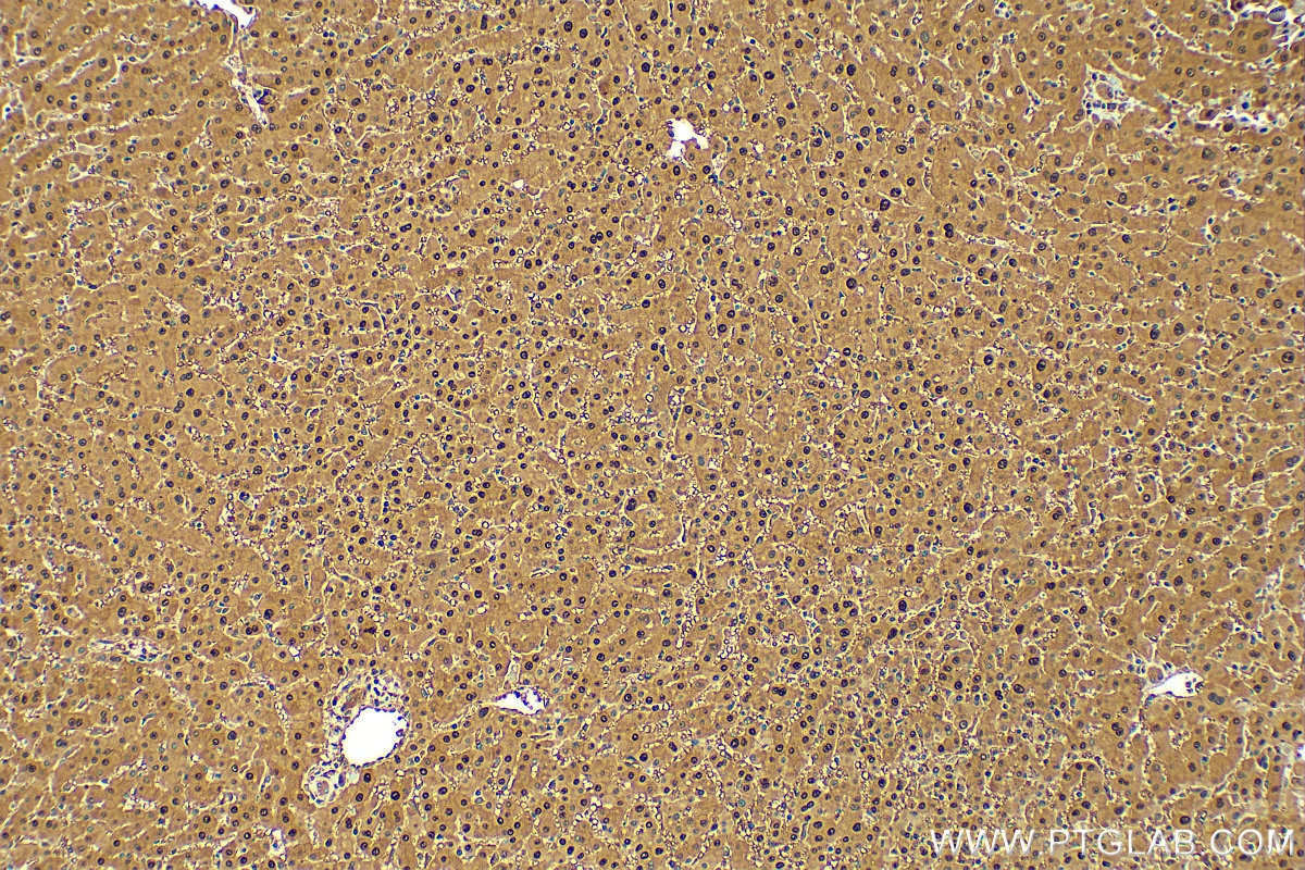 Immunohistochemistry (IHC) staining of human hepatocirrhosis tissue using PGM1 Polyclonal antibody (15161-1-AP)