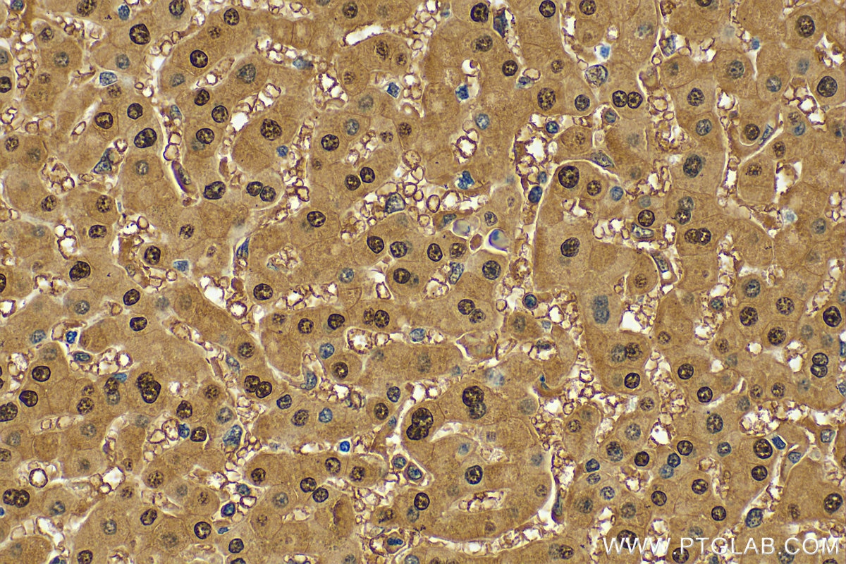 Immunohistochemistry (IHC) staining of human hepatocirrhosis tissue using PGM1 Polyclonal antibody (15161-1-AP)