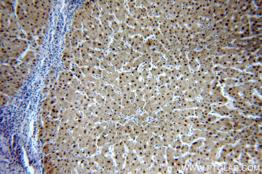 Immunohistochemistry (IHC) staining of human hepatocirrhosis tissue using PGM1 Polyclonal antibody (15161-1-AP)