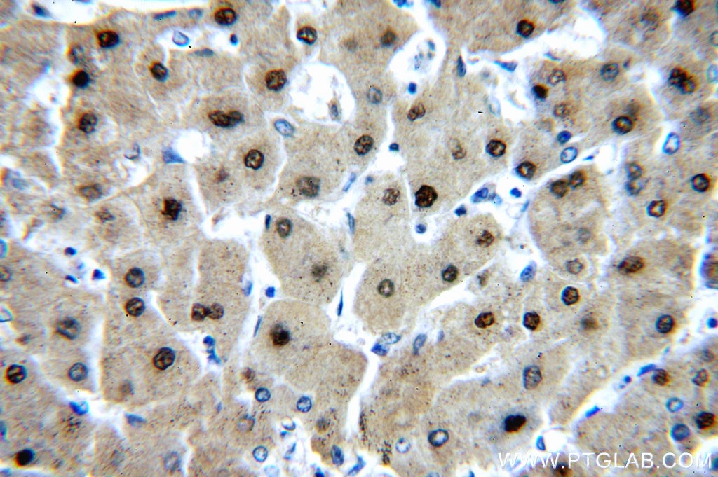 Immunohistochemistry (IHC) staining of human hepatocirrhosis tissue using PGM1 Polyclonal antibody (15161-1-AP)