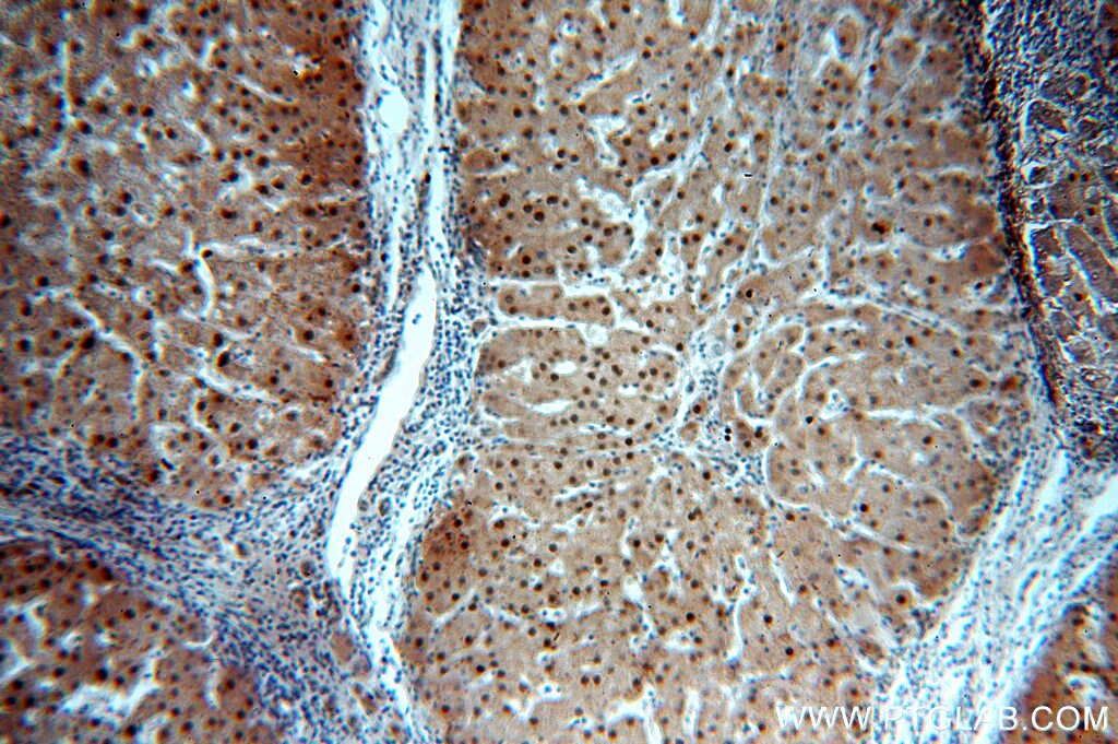 Immunohistochemistry (IHC) staining of human hepatocirrhosis tissue using PGM1 Polyclonal antibody (15161-1-AP)