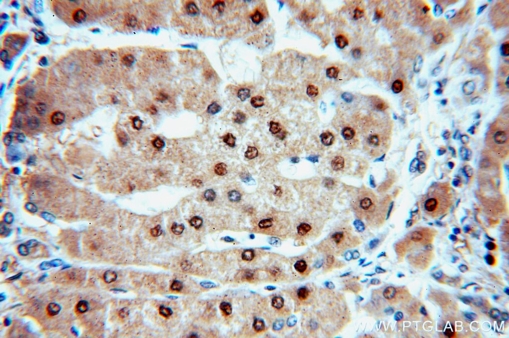 Immunohistochemistry (IHC) staining of human hepatocirrhosis tissue using PGM1 Polyclonal antibody (15161-1-AP)
