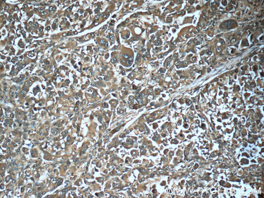 IHC staining of human liver cancer using 66105-1-Ig