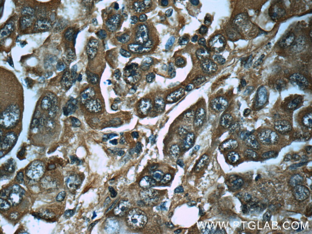 Immunohistochemistry (IHC) staining of human liver cancer tissue using PGM1 Monoclonal antibody (66105-1-Ig)