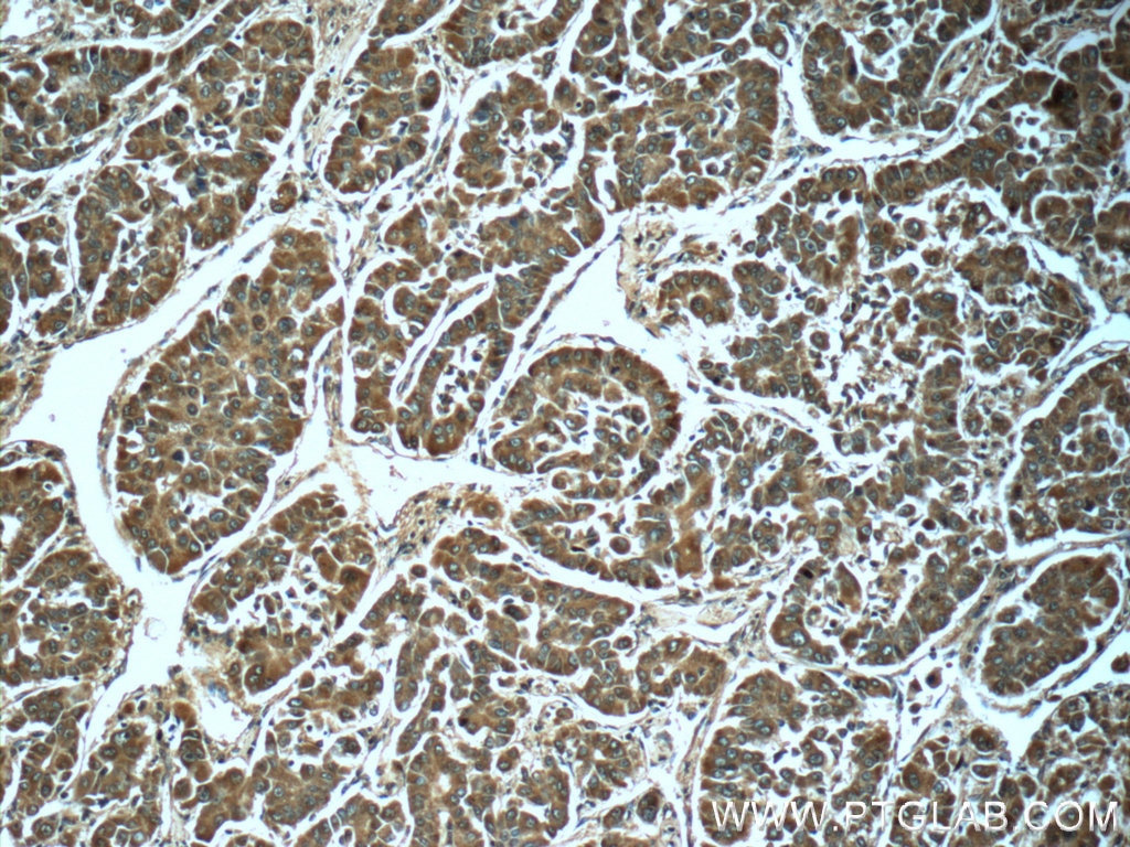 Immunohistochemistry (IHC) staining of human liver cancer tissue using PGM1 Monoclonal antibody (66105-1-Ig)