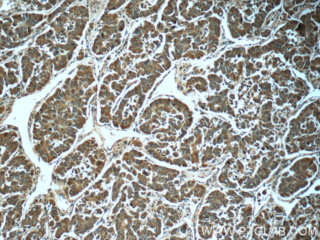 IHC staining of human liver cancer using 66105-1-Ig