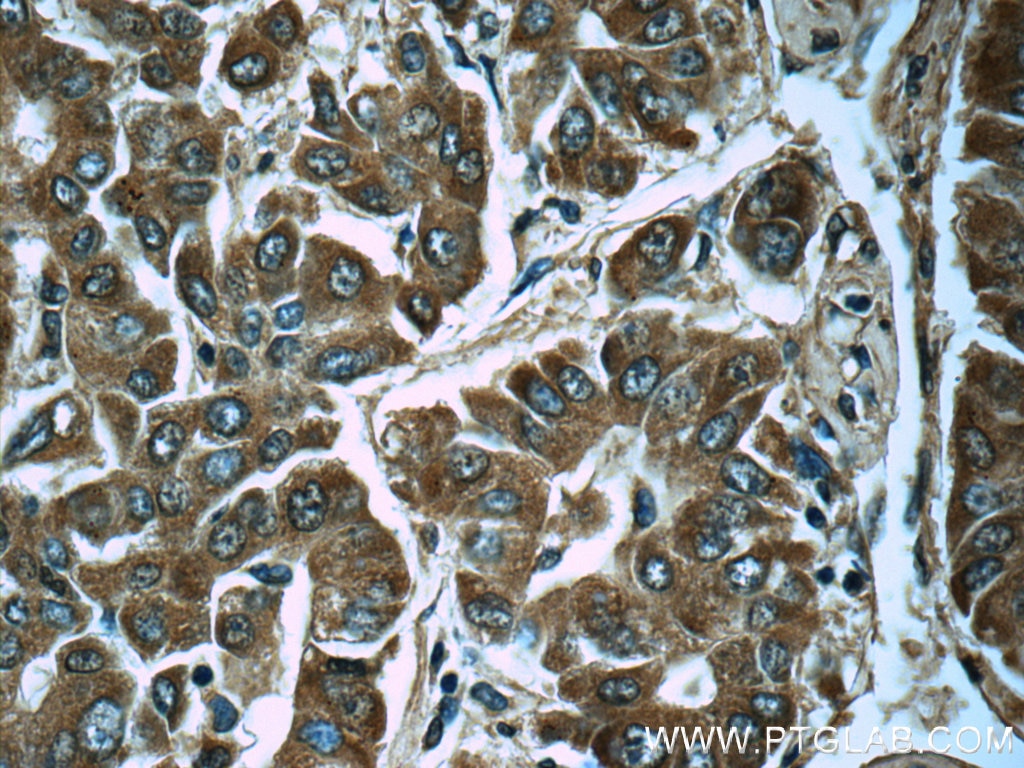 Immunohistochemistry (IHC) staining of human liver cancer tissue using PGM1 Monoclonal antibody (66105-1-Ig)