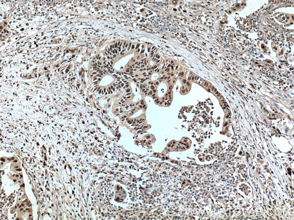 Immunohistochemistry (IHC) staining of human pancreas cancer tissue using PGM2 Polyclonal antibody (11022-1-AP)