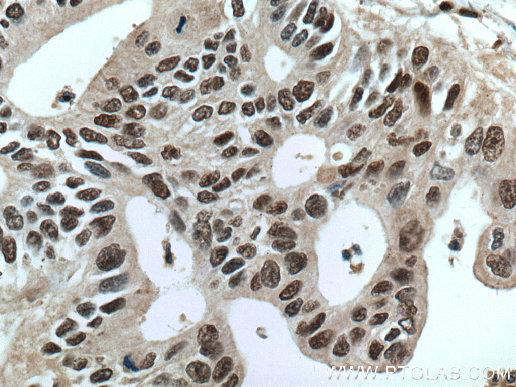 Immunohistochemistry (IHC) staining of human pancreas cancer tissue using PGM2 Polyclonal antibody (11022-1-AP)