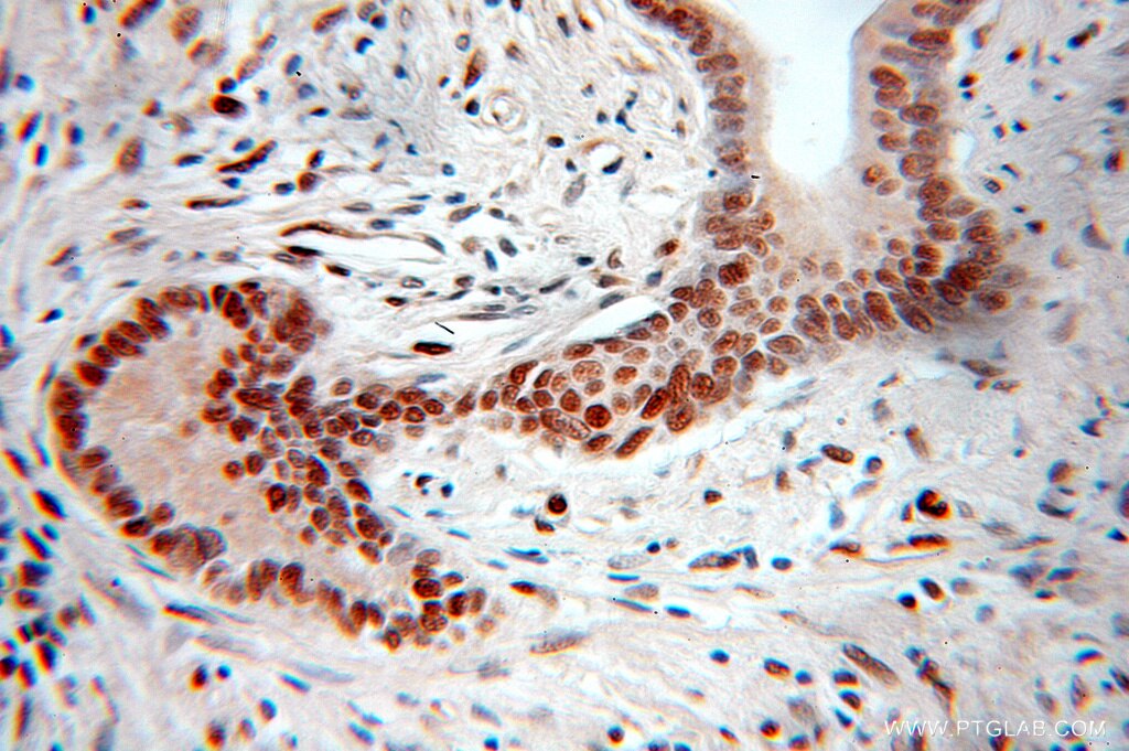 Immunohistochemistry (IHC) staining of human pancreas cancer tissue using PGM2 Polyclonal antibody (11022-1-AP)