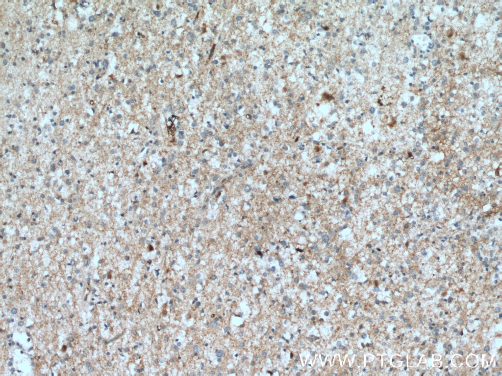 Immunohistochemistry (IHC) staining of human gliomas tissue using PGM2L1 Polyclonal antibody (13942-1-AP)