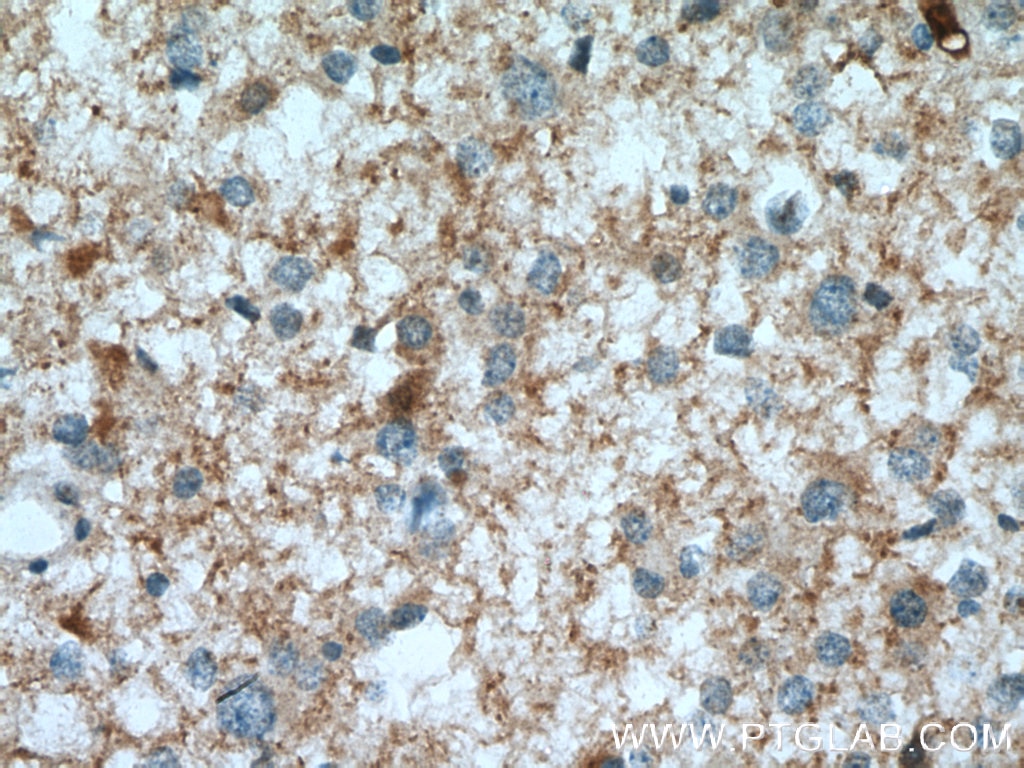 Immunohistochemistry (IHC) staining of human gliomas tissue using PGM2L1 Polyclonal antibody (13942-1-AP)