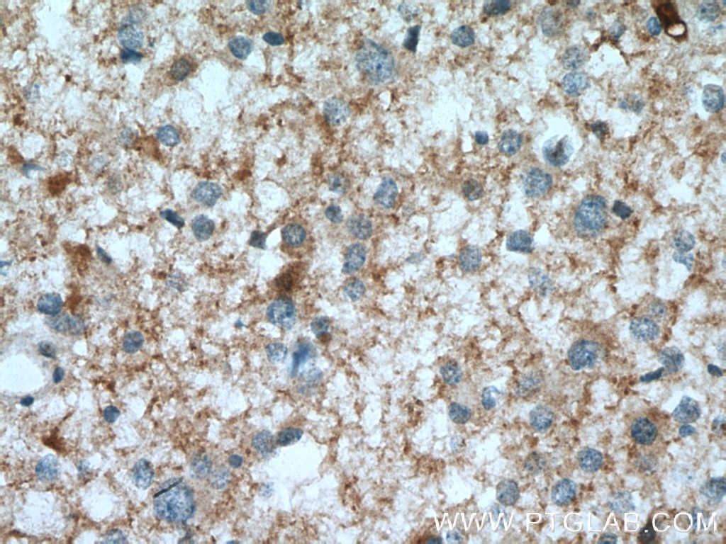 IHC staining of human gliomas using 13942-1-AP