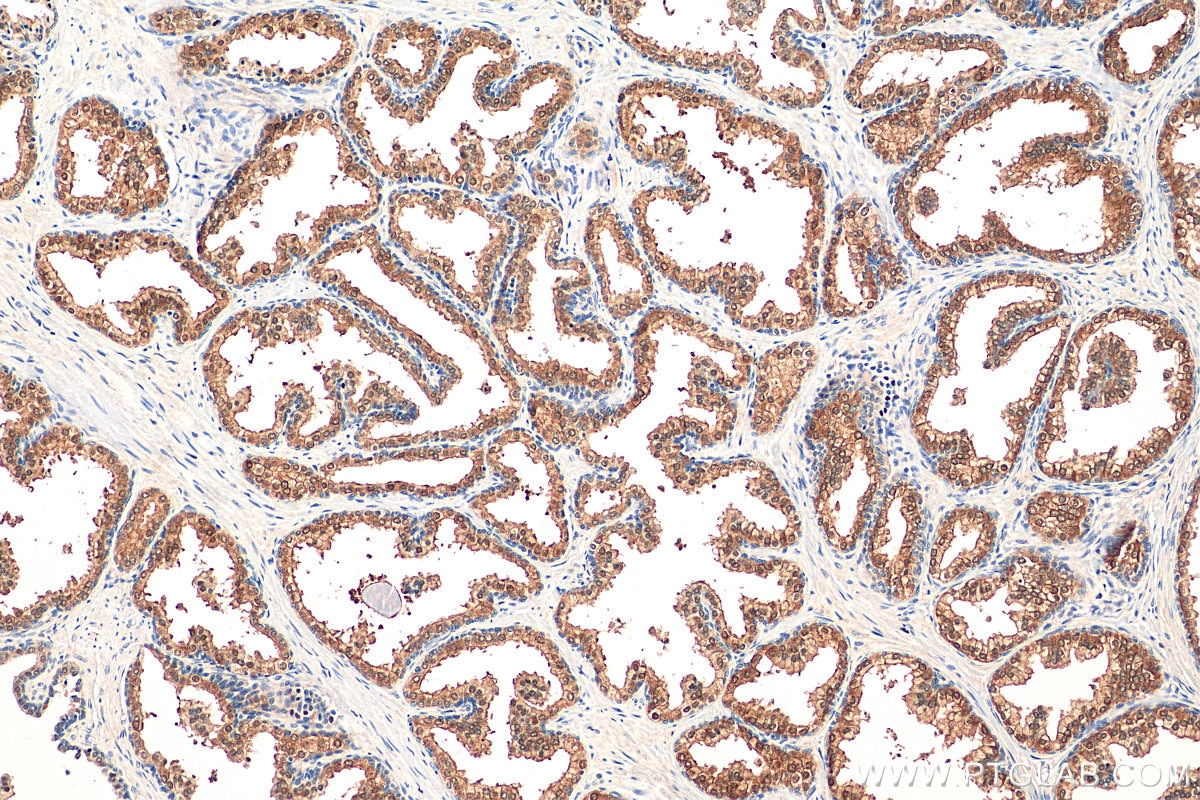 Immunohistochemistry (IHC) staining of human prostate hyperplasia tissue using PGM3 Polyclonal antibody (29686-1-AP)