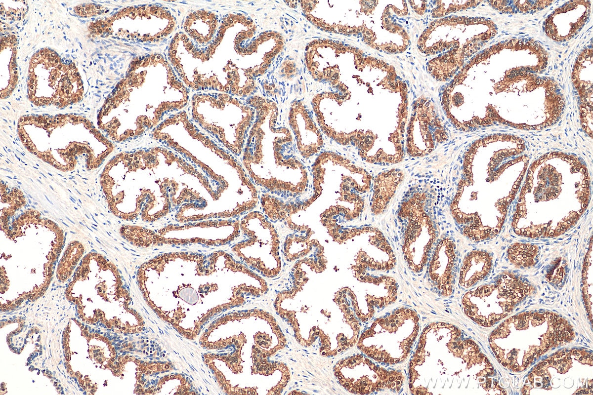 IHC staining of human prostate hyperplasia using 29686-1-AP