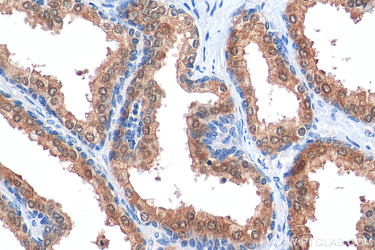 Immunohistochemistry (IHC) staining of human prostate hyperplasia tissue using PGM3 Polyclonal antibody (29686-1-AP)