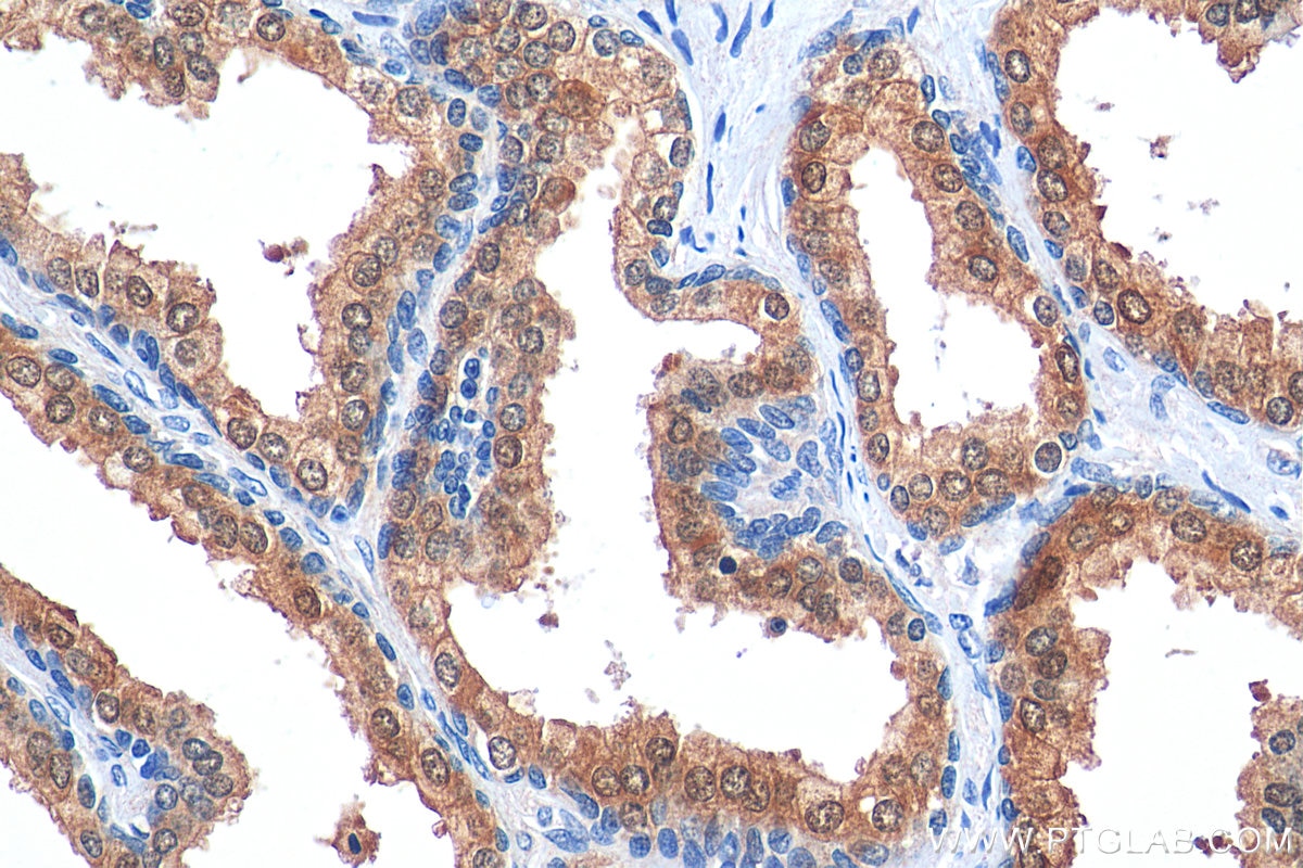 IHC staining of human prostate hyperplasia using 29686-1-AP