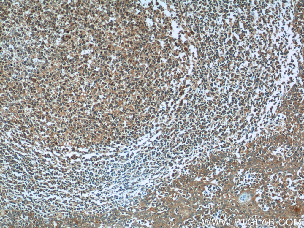 Immunohistochemistry (IHC) staining of human tonsillitis tissue using PGP Polyclonal antibody (25081-1-AP)