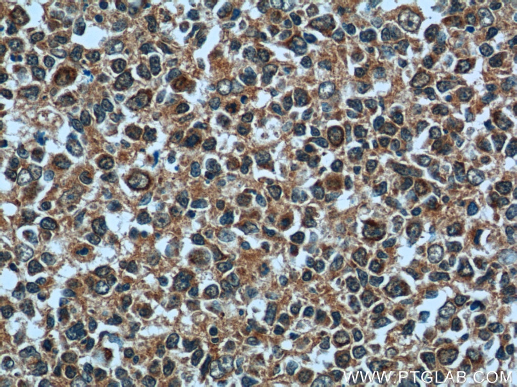 Immunohistochemistry (IHC) staining of human tonsillitis tissue using PGP Polyclonal antibody (25081-1-AP)