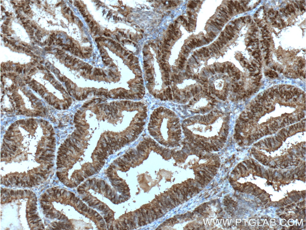 Immunohistochemistry (IHC) staining of human breast cancer tissue using PR Polyclonal antibody (19980-1-AP)