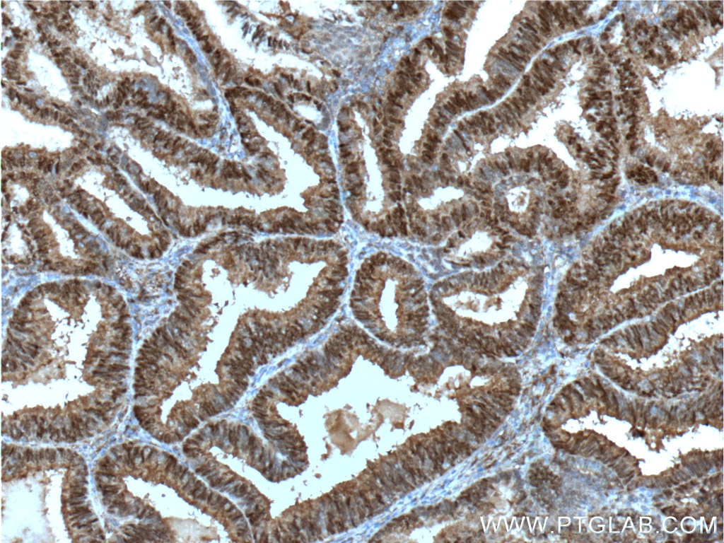 Immunohistochemistry (IHC) staining of human breast cancer tissue using PR Polyclonal antibody (19980-1-AP)