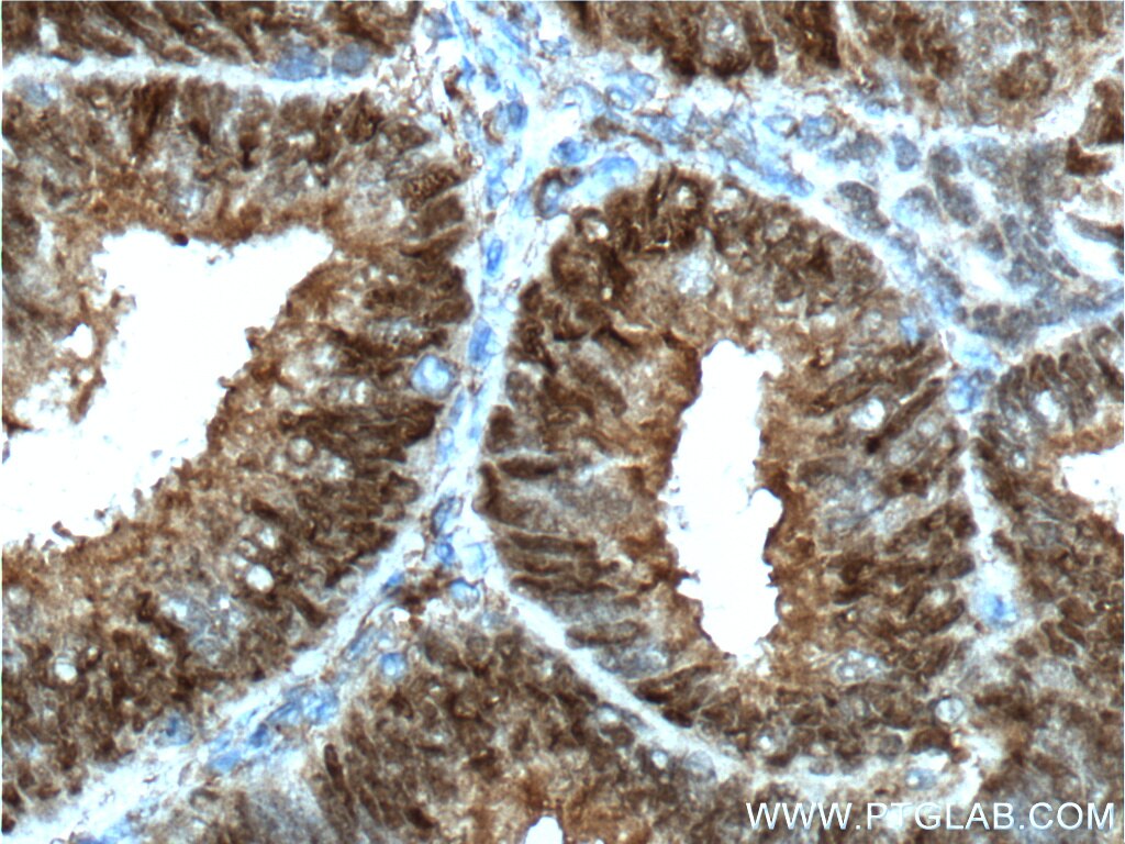 Immunohistochemistry (IHC) staining of human breast cancer tissue using PR Polyclonal antibody (19980-1-AP)