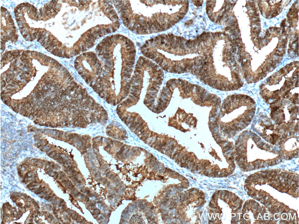 Immunohistochemistry (IHC) staining of human breast cancer tissue using PR Polyclonal antibody (19980-1-AP)