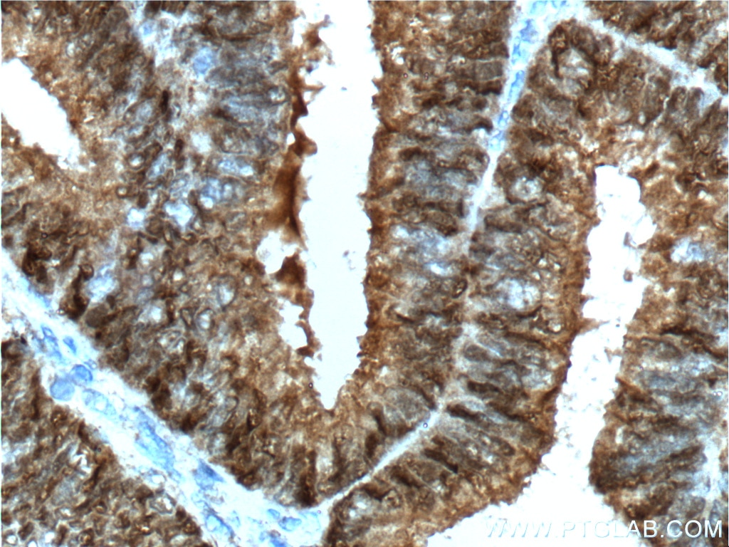 Immunohistochemistry (IHC) staining of human breast cancer tissue using PR Polyclonal antibody (19980-1-AP)