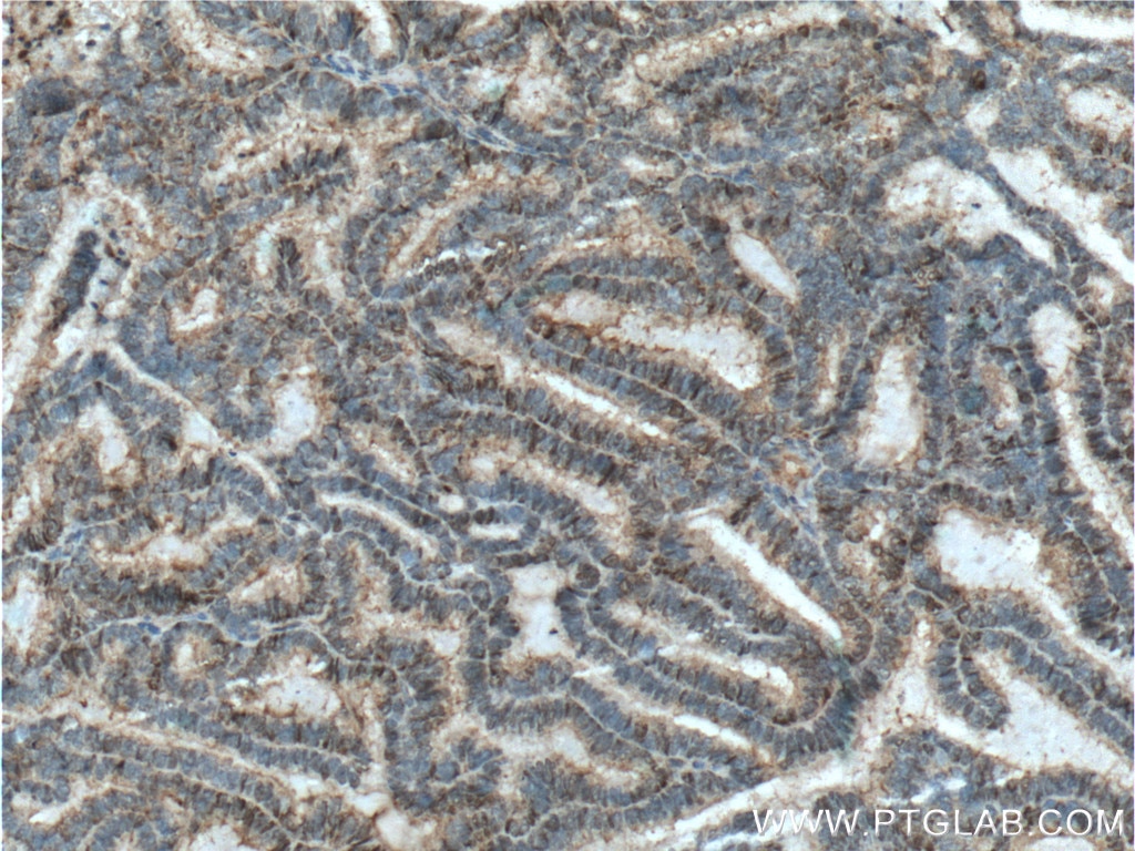 Immunohistochemistry (IHC) staining of human breast cancer tissue using PR Polyclonal antibody (19980-1-AP)