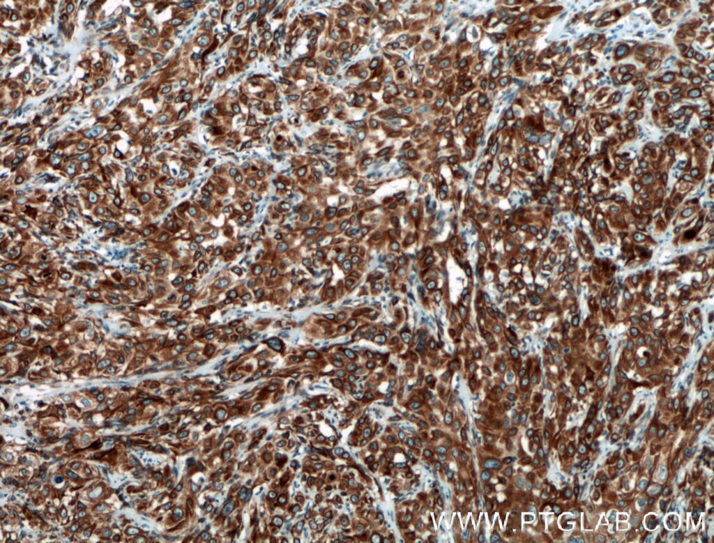 Immunohistochemistry (IHC) staining of human cervical cancer tissue using PGRMC1 Polyclonal antibody (12990-1-AP)