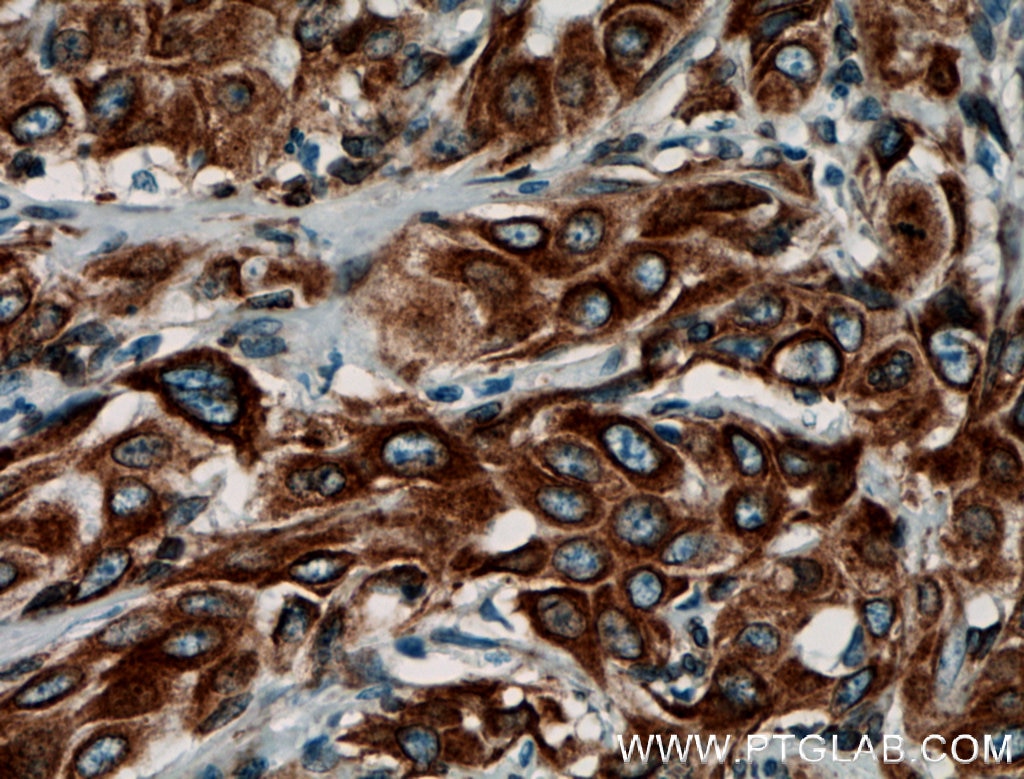 Immunohistochemistry (IHC) staining of human cervical cancer tissue using PGRMC1 Polyclonal antibody (12990-1-AP)