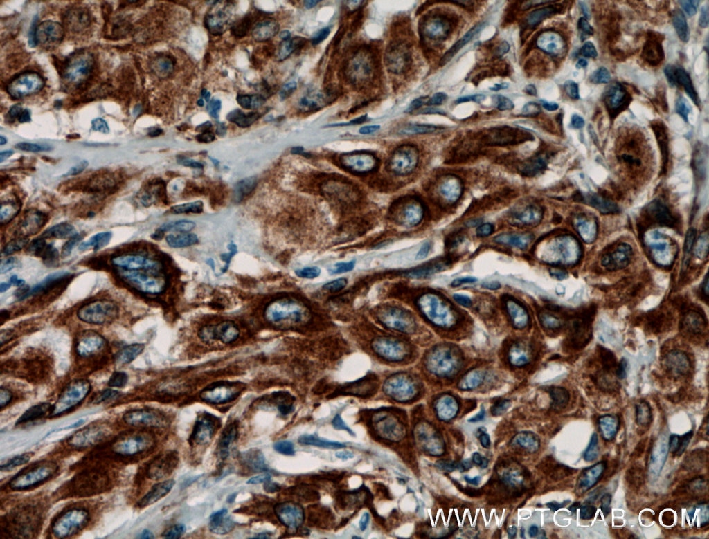 Immunohistochemistry (IHC) staining of human cervical cancer tissue using PGRMC1 Polyclonal antibody (12990-1-AP)