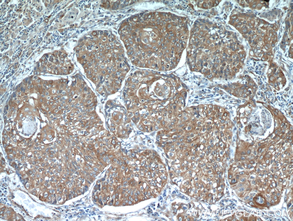 Immunohistochemistry (IHC) staining of human lung cancer tissue using PGRMC1 Polyclonal antibody (12990-1-AP)