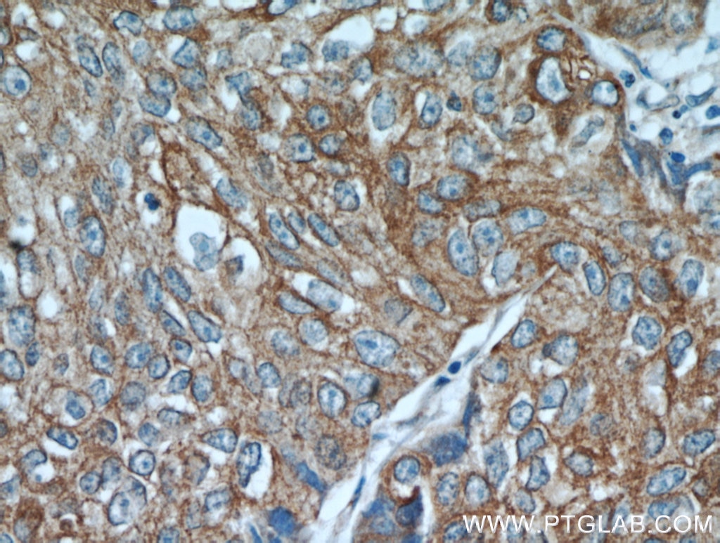 Immunohistochemistry (IHC) staining of human lung cancer tissue using PGRMC1 Polyclonal antibody (12990-1-AP)