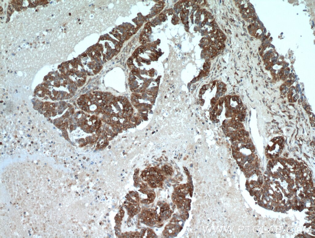 Immunohistochemistry (IHC) staining of human ovary tumor tissue using PGRMC1 Polyclonal antibody (12990-1-AP)