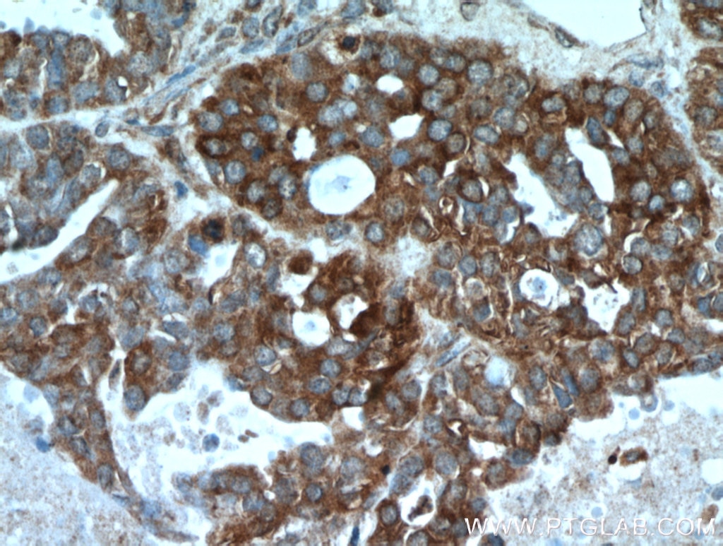 Immunohistochemistry (IHC) staining of human ovary tumor tissue using PGRMC1 Polyclonal antibody (12990-1-AP)