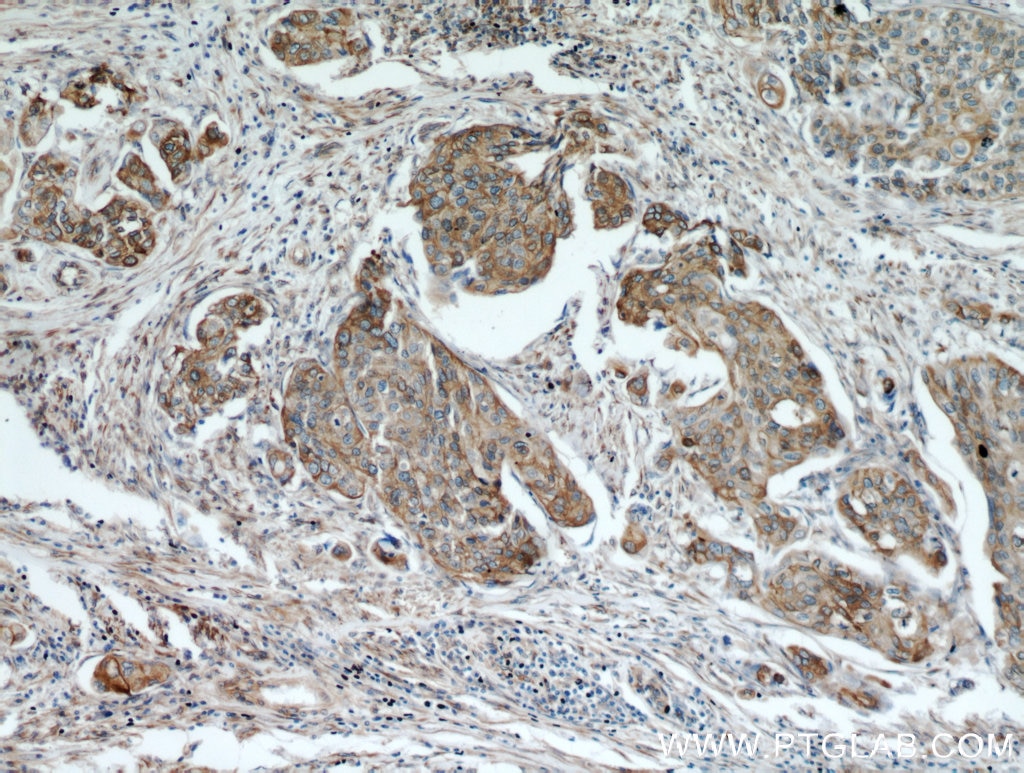 Immunohistochemistry (IHC) staining of human cervical cancer tissue using PGRMC1 Polyclonal antibody (12990-1-AP)