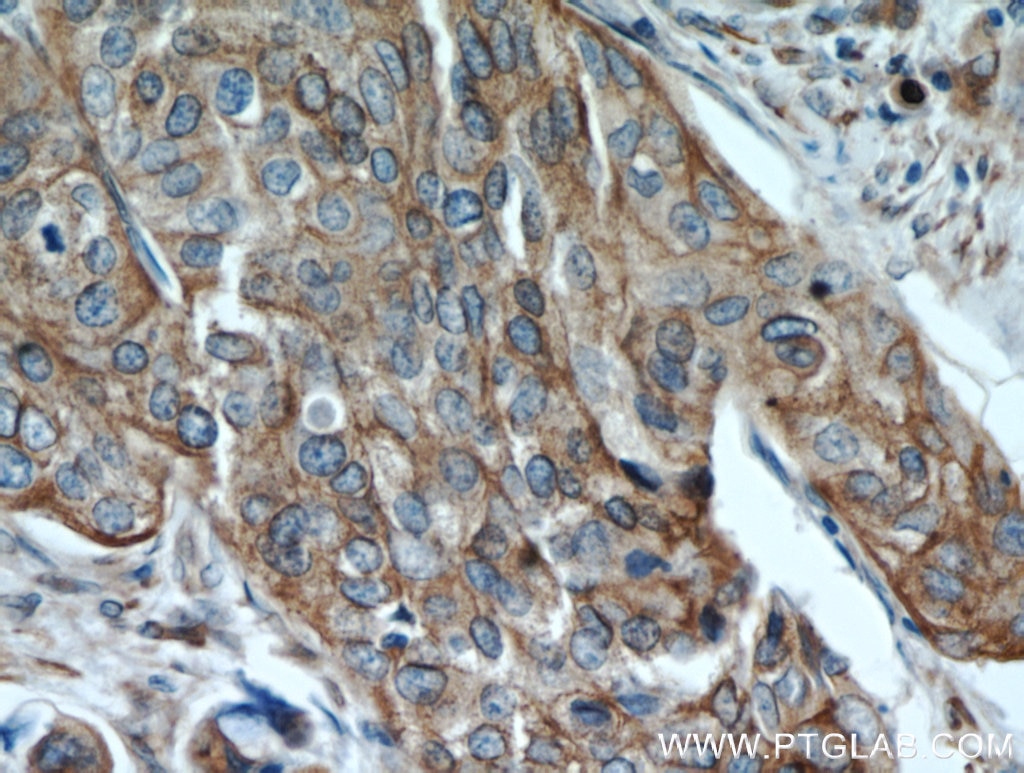 Immunohistochemistry (IHC) staining of human cervical cancer tissue using PGRMC1 Polyclonal antibody (12990-1-AP)