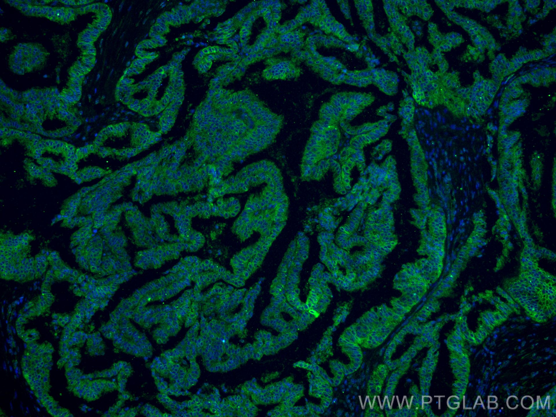 Immunofluorescence (IF) / fluorescent staining of human ovary tumor tissue using PGRMC1 Monoclonal antibody (66372-1-Ig)