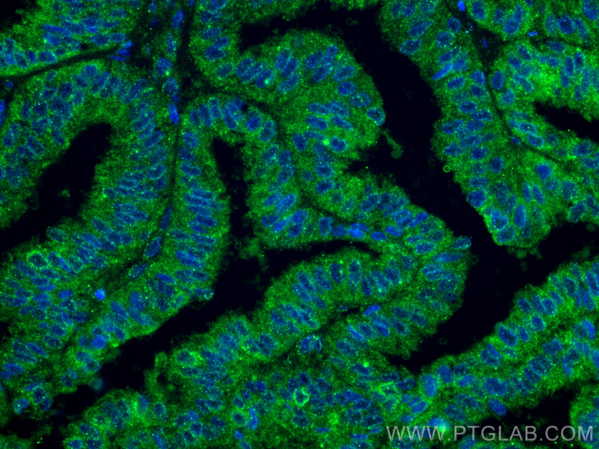 Immunofluorescence (IF) / fluorescent staining of human ovary tumor tissue using PGRMC1 Monoclonal antibody (66372-1-Ig)