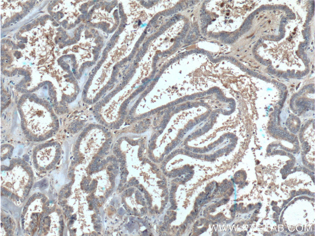 IHC staining of human ovary tumor using 66372-1-Ig