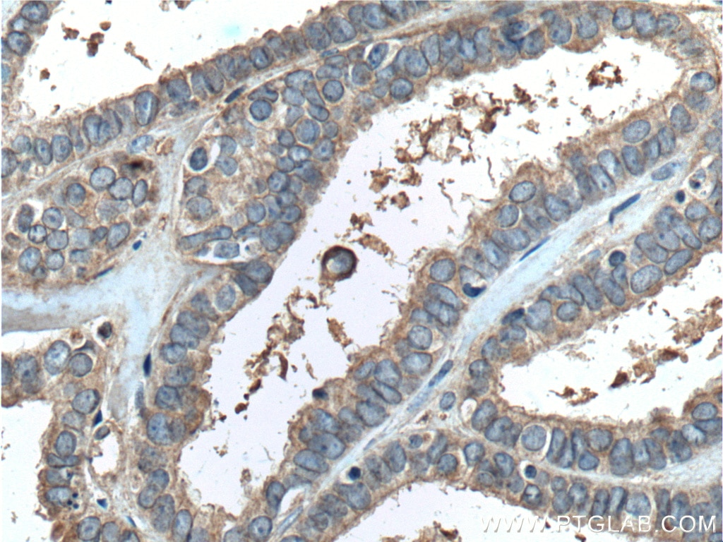 Immunohistochemistry (IHC) staining of human ovary tumor tissue using PGRMC1 Monoclonal antibody (66372-1-Ig)