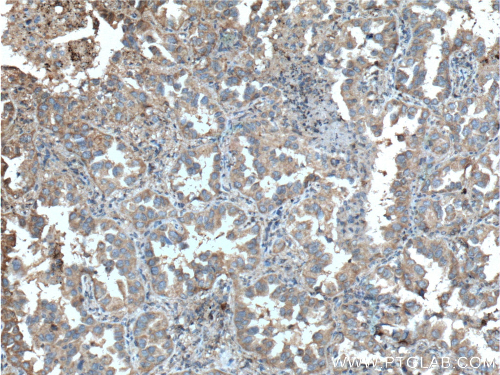 Immunohistochemistry (IHC) staining of human lung cancer tissue using PGRMC1 Monoclonal antibody (66372-1-Ig)