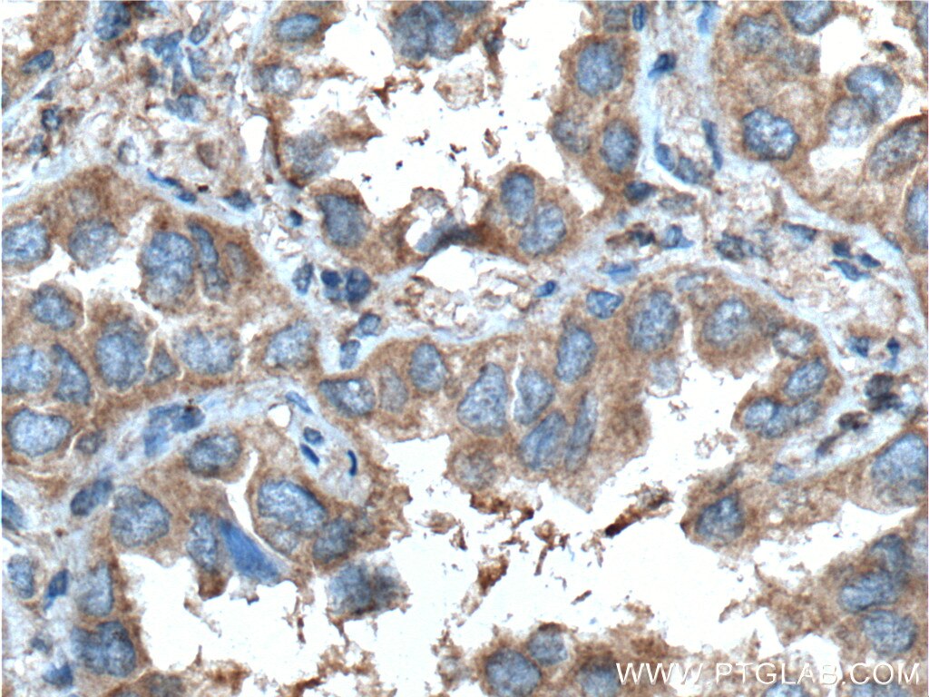 Immunohistochemistry (IHC) staining of human lung cancer tissue using PGRMC1 Monoclonal antibody (66372-1-Ig)